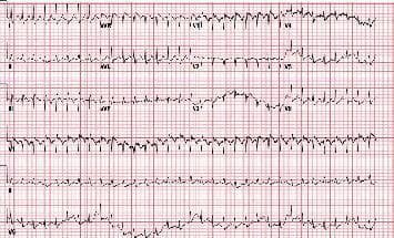 This diagnostic image is a 12-lead electrocardiogram (ECG) demonstrating a rapid, regular rhythm with narrow QRS complexes, consistent with supraventricular tachycardia (SVT). A hallmark feature of acute right heart strain is visible via the S1Q3T3 pattern: lead I shows a prominent S-wave, lead III displays a significant Q-wave, and there is T-wave inversion also in lead III. The tracing exhibits tachycardia with a rate exceeding 100 beats per minute. These findings are clinically significant for diagnosing pulmonary embolism or other causes of acute pulmonary hypertension in an emergency or critical care setting. The ECG is presented on standard pink grid paper, showing limb leads (I, II, III, aVR, aVL, aVF) and precordial leads (V1-V6) alongside a rhythm strip.