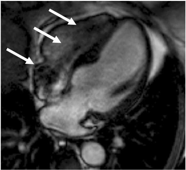 This diagnostic image is a steady-state free precession (SSFP) cine cardiac MRI in a four-chamber horizontal long-axis view. The image clearly depicts the internal anatomy of the heart, including the left and right atria, left and right ventricles, and the interventricular septum. A prominent feature of the image is the presence of metal-induced susceptibility artifacts, indicated by white arrows. These artifacts appear as localized regions of signal void and peripheral distortion along the right heart border, corresponding to the positioning of implanted dual-chamber pacemaker leads. This image serves as an educational example of how metallic implants impact cardiac MRI signal quality, specifically illustrating the 'blooming' effect that can obscure myocardial and blood pool detail in patients with MRI-conditional cardiovascular electronic devices (CIEDs).