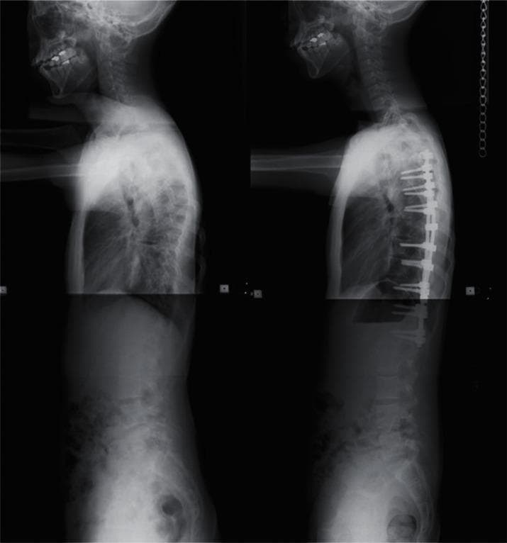 This diagnostic image consists of two side-by-side lateral x-ray radiographs of the human spine, demonstrating a 'before and after' comparison of surgical correction for spinal deformity. The left panel shows a preoperative state characterized by severe thoracic kyphosis and a compensatory forward head posture with loss of normal cervical lordosis. The right panel demonstrates the postoperative outcome following posterior spinal fusion. Visible medical instrumentation includes a segmental pedicle screw construct, featuring multiple pedicle screws anchored into the thoracic and upper lumbar vertebral bodies, connected by longitudinal stabilization rods. This surgical intervention has resulted in significant reduction of the kyphotic curvature and improved sagittal balance, aligning the head more vertically over the pelvis. The images serve as an educational example of orthopedic spinal reconstruction and the use of modern internal fixation systems to treat adolescent or adult idiopathic scoliosis and kyphosis.