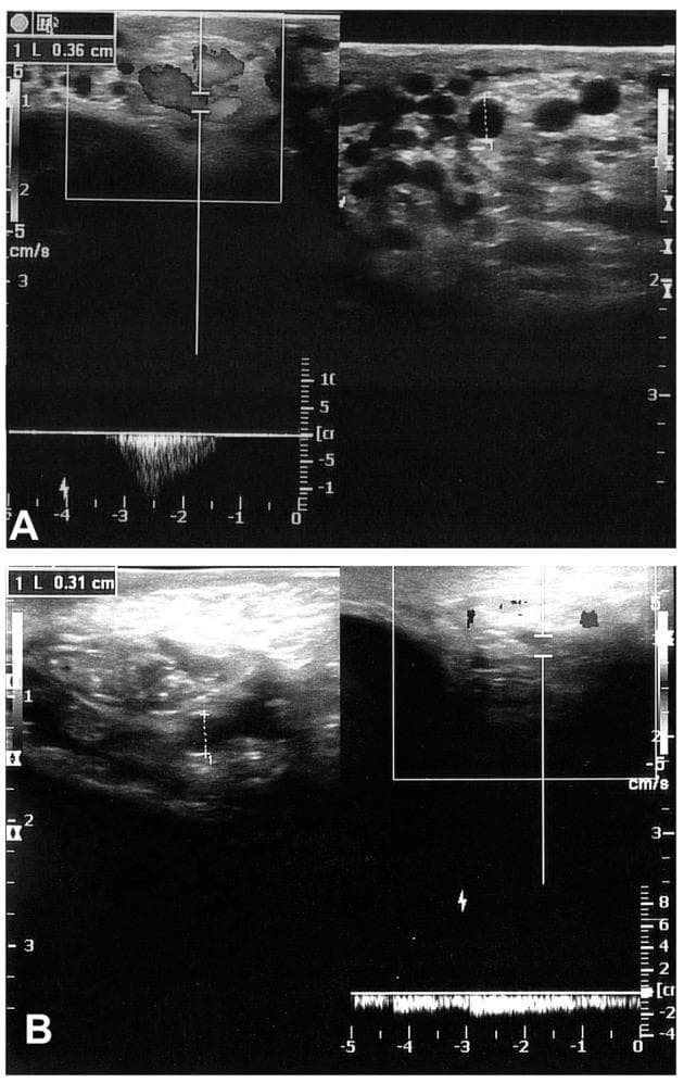 Diagnostic Color Doppler Sonography (CDS) of the scrotum in two patients (A and B) evaluated 6 months post-surgery for varicocele. Image A shows a grayscale ultrasound of the pampiniform plexus with multiple dilated, anechoic, round-to-ovoid venous structures. A caliper measurement indicates a vein diameter of 0.36 cm. The corresponding color Doppler and spectral waveform demonstrate significant retrograde flow (reflux) induced by the Valsalva maneuver, characteristic of recurrent varicocele. Image B displays a similar examination in a different patient, showing a measured venous diameter of 0.31 cm. Compared to A, the color Doppler signal in B is more sparse and intermittent, though still indicating persistent reflux. These images illustrate the use of ultrasound to identify clinical recurrence of varicoceles by measuring venous diameter and documenting the duration and velocity of Valsalva-induced reflux in the spermatic veins.