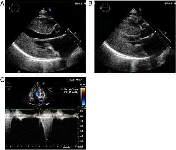 Transthoracic echocardiographic images demonstrating diagnostic features of hypertrophic obstructive cardiomyopathy (HOCM). Panels A and B present parasternal long-axis views. Panel A shows the heart in end-diastole with severe, diffuse left ventricular (LV) hypertrophy, particularly involving the interventricular septum and posterior wall. Panel B shows the heart in end-systole, highlighting significant chamber obliteration and the characteristic systolic anterior motion (SAM) of the anterior mitral valve leaflet. Panel C displays Doppler echocardiography, incorporating a color flow mapping sector and continuous-wave (CW) Doppler spectral tracing. The CW Doppler shows a high-velocity, late-peaking systolic jet characteristic of dynamic left ventricular outflow tract (LVOT) obstruction. Quantitative measurements indicate a peak velocity of 467 cm/s and a calculated peak pressure gradient of 87 mmHg, confirming severe outflow obstruction. These visuals are educationally significant for identifying phenotypic markers of cardiac hypertrophy and quantifying hemodynamic gradients in cardiomyopathy.