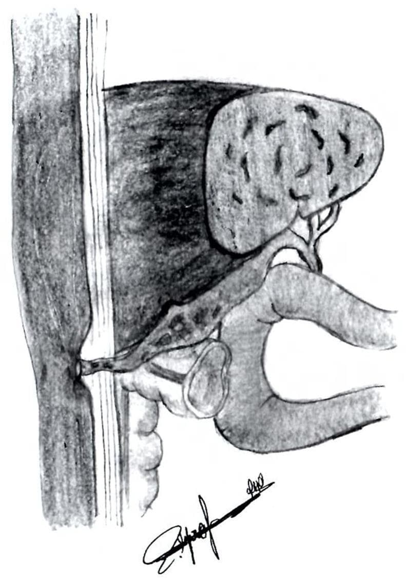 This medical illustration depicts a cholecystocutaneous fistula, a rare type of external biliary fistula. The grayscale diagram shows the anatomical relationship between the gallbladder, the biliary system, and the abdominal wall. The gallbladder is rendered with a textured, stippled surface, indicating potential inflammation or cholelithiasis, and is situated inferior to the liver. A pathological tubular tract (the fistula) is shown originating from the fundus or body of the gallbladder, extending anteriorly to penetrate through the muscular layers of the abdominal wall and the subcutaneous tissue, ultimately opening onto the skin surface. Surrounding structures, including the liver and segments of the intestine, provide anatomical context for the pathway of the tract. The illustration is designed to teach the pathophysiology of spontaneous or post-inflammatory biliary drainage to the exterior environment, emphasizing the abnormal connection between an internal organ and the cutaneous surface.