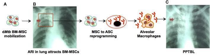 This pathophysiology diagram and clinical imaging sequence illustrate the development of Post-Primary Tuberculosis of the Lung (PPTBL) involving bone marrow-derived mesenchymal stem cells (BM-MSCs). Panel A depicts the mobilization of dormant Mycobacterium tuberculosis (dMtb)-harboring BM-MSCs, triggered by acute respiratory tract infection (ARI). Panel B features a chest X-ray of a subclinical phase, showing a focal pneumonia-like exudative opacity in the right lung apex (indicated by a red arrow). The diagram shows the subsequent reprogramming of MSCs into 'altruistic stem cells' (ASCs) which facilitate Mtb replication and infection of alveolar macrophages. Panel C presents a clinical PPTBL chest X-ray showing disease progression; the red arrow highlights more prominent, extensive opacities and cavitary lesions in the right upper lobe. The visual summarizes the transition from stem cell-mediated dMtb latency to active clinical disease characterized by host immune response, granuloma formation, and pulmonary cavitation. This material is designed for medical education focusing on immunology, pulmonology, and infectious disease mechanisms.