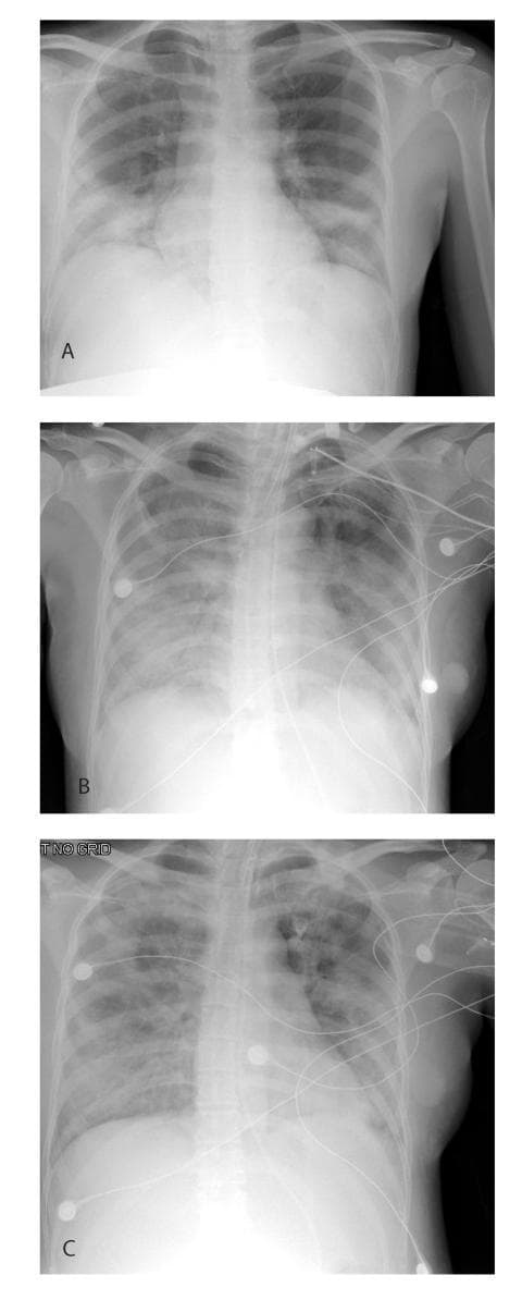 A series of three sequential anteroposterior (AP) chest radiographs (labeled A, B, and C) illustrating the progression and resolution of viral pneumonia in a pregnant patient with Severe Acute Respiratory Syndrome (SARS). Radiograph A (Day 6 of illness) shows diffuse bilateral lower lobe pulmonary infiltrates with relative sparing of the upper zones. Radiograph B (Day 10) demonstrates significant radiographic progression, characterized by worsening bilateral consolidations and ground-glass opacities, consistent with acute respiratory distress syndrome (ARDS). Supportive medical equipment is visible in image B, including an endotracheal tube, a central venous catheter, and ECG leads, indicating critical care management. Radiograph C (Day 13) shows interval improvement of the bilateral pulmonary opacities, reflecting clinical recovery and response to therapy, though residual infiltrates remain. This timeline serves as a clinical example of the rapid evolution and subsequent resolution phase of severe coronavirus-related lung injury in an obstetric context.