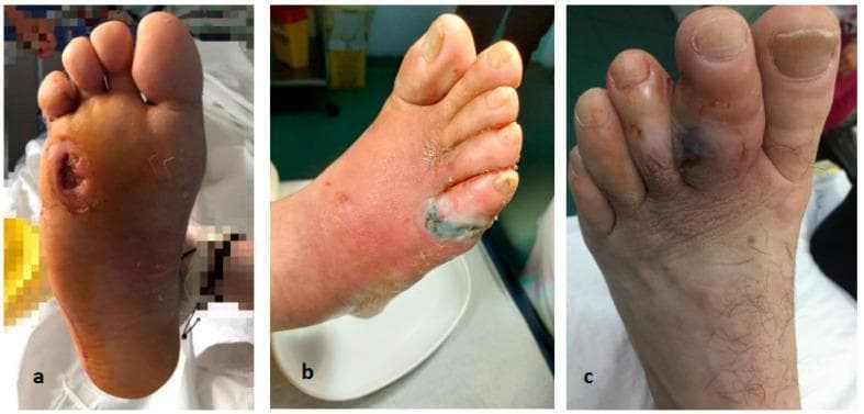 This set of clinical photographs illustrates three common complications of the diabetic foot. Panel A shows a deep plantar ulcer located over the first metatarsophalangeal joint. The lesion is circular with hyperkeratotic, raised edges and a granular base, characteristic of a neuropathic ulcer. Panel B demonstrates toe gangrene and necrosis, featuring significant tissue darkening (purplish-black) and desquamation involving the distal forefoot and toes, accompanied by surrounding erythema suggesting cellulitis. Panel C displays the dorsal aspect of a foot with toe osteitis, characterized by marked swelling (edema), cyanotic discoloration of the third and fourth digits, and signs of inflammatory soft tissue involvement. Collectively, these images represent the clinical spectrum of diabetic foot infections and peripheral vascular complications, ranging from localized ulceration to tissue necrosis and underlying bone inflammation (osteitis), which are critical for surgical triage and management in podiatry and vascular surgery.