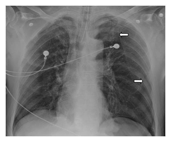 This diagnostic image is an anteroposterior (AP) chest X-ray of a patient in a clinical setting, as evidenced by the presence of an endotracheal tube and ECG leads. The radiograph demonstrates bilateral pulmonary hyperinflation with a notable increase in radiolucency. Specifically, the left lung displays multiple large, focal areas of hyperlucency located at the apex and base. These regions are demarcated by thin, curvilinear, radiopaque borders (indicated by white arrows), which are characteristic of bullae walls. The overall lung volume is increased, with flattening of the diaphragmatic contours. These findings are highly suggestive of Vanishing Lung Syndrome (idiopathic giant bullous emphysema) or advanced bullous emphysema. The image serves as an educational example of how large subpleural bullae can occupy significant portions of the hemithorax, leading to compressive effects on the surrounding lung parenchyma and clinical respiratory compromise.
