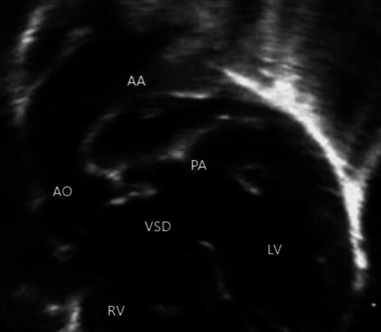 A grayscale two-dimensional (2D) echocardiogram image illustrating complex congenital heart disease anatomy, specifically Tetralogy of Fallot (TOF) associated with pulmonary atresia and a patent ductus arteriosus (PDA). The image shows the aortic arch (AA) superiorly and the descending aorta (AO). Key cardiac structures are labeled, including the right ventricle (RV), left ventricle (LV), and a prominent ventricular septal defect (VSD) indicating an interventricular communication. The pulmonary artery (PA) is visualized originating from the undersurface of the aortic arch, characteristic of ductal-dependent pulmonary circulation in the setting of pulmonary atresia. This diagnostic image demonstrates the spatial relationships between the great vessels and the ventricles required for the clinical management of cyanotic congenital heart defects in pediatric patients. Labels present: AA (Aortic Arch), AO (Aorta), PA (Pulmonary Artery), VSD (Ventricular Septal Defect), LV (Left Ventricle), and RV (Right Ventricle).