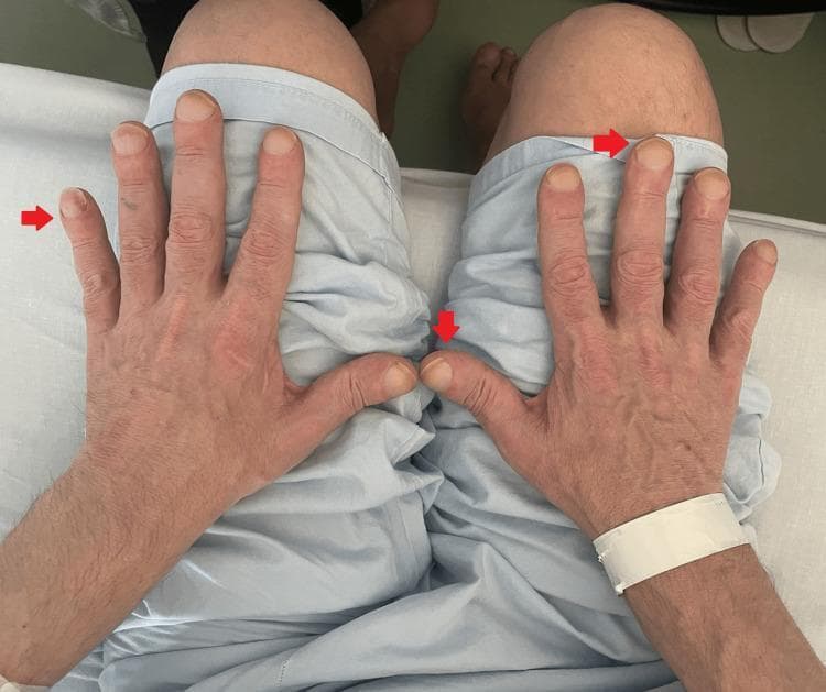 Clinical photograph of the dorsal aspect of both hands in a patient, demonstrating digital clubbing (Hippocratic fingers). Red arrows highlight the bulbous, drumstick-like enlargement of the distal phalanges. The nailbeds exhibit increased convexity and a rounded, 'watch-glass' appearance, indicating a loss of the normal Schamroth window angle. The skin on the hands appears thin with visible dorsal venous patterns and a small scar on the left hand. This finding is a clinical sign often associated with chronic hypoxemia, underlying pulmonary malignancy (such as the lung mass noted in the clinical context), or hypertrophic osteoarthropathy (HOA). The photograph serves as an educational tool for identifying physical manifestations of systemic disease during a rheumatological or respiratory examination.