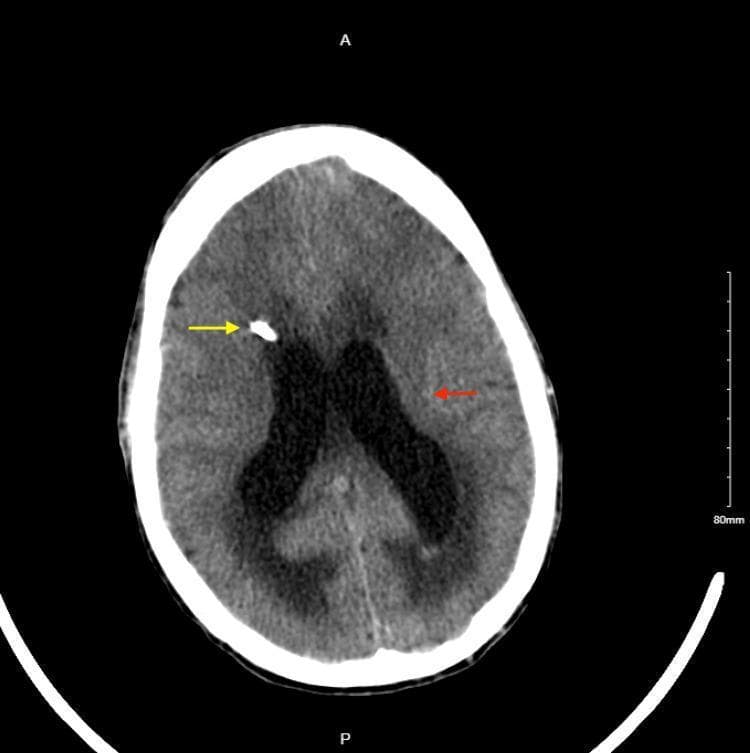 This axial non-contrast CT scan of the head demonstrates the placement of a right-sided external ventricular drain (EVD) in a patient with hydrocephalus. A high-density catheter is visible entering through the right frontal calvarium (yellow arrow), with its trajectory directed toward the ventricular system to facilitate cerebrospinal fluid (CSF) diversion. The lateral ventricles show interval decreased dilation compared to previous states, although they remain prominent. There is a notable reduction in periventricular hypodensity, representing decreased subependymal edema (red arrow) within the white matter surrounding the lateral ventricles. The brain parenchyma shows improved visualization of sulci compared to an acute obstructive state, indicating effective decompression of intracranial pressure. This diagnostic image is used to illustrate post-procedural management of increased intracranial pressure and the radiographic resolution of transependymal flow.