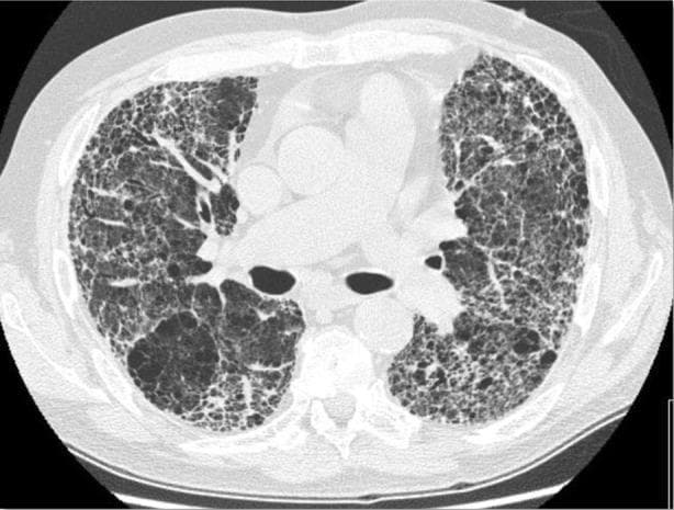 Axial non-contrast computed tomography (CT) of the chest demonstrating advanced interstitial lung disease. The imaging shows a classic Usual Interstitial Pneumonia (UIP) pattern characteristic of Idiopathic Pulmonary Fibrosis (IPF). Prominent bilateral, predominantly peripheral, and subpleural reticular opacities are present throughout the lung parenchyma. There is significant architectural distortion featuring extensive honeycombing, characterized by clusters of cystic airspaces with thickened walls. Associated findings include traction bronchiectasis, where secondary fibrotic changes cause pathological dilation of the bronchi, and thickened interlobular septa. Some ground-glass opacities are interspersed within the reticular network. The mediastinal structures and great vessels are visible centrally. This visual information is clinically relevant for the diagnosis of chronic fibrosing interstitial pneumonia and serves as a primary example of severe parenchymal destruction in elderly ex-smokers.