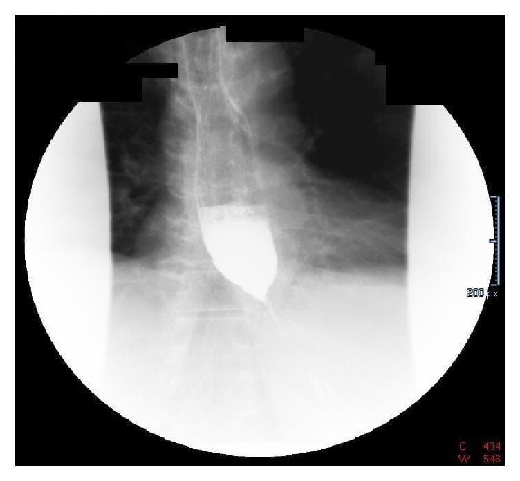 A diagnostic fluoroscopic image of a barium swallow (esophagram) demonstrating classic radiologic features of achalasia or pseudoachalasia. The image shows a markedly dilated thoracic esophagus filled with radiopaque barium contrast. There is a characteristic abrupt, symmetrical tapering of the distal esophagus at the gastroesophageal junction, creating the diagnostic 'bird's beak' appearance. Significant barium column stasis is visible proximal to the lower esophageal sphincter, indicating functional or mechanical obstruction. Minimal contrast is seen passing into the stomach, which is partially visualized in the lower quadrant. This finding is highly suggestive of impaired lower esophageal sphincter relaxation or extrinsic compression, correlating clinically with symptoms such as progressive dysphagia and weight loss.