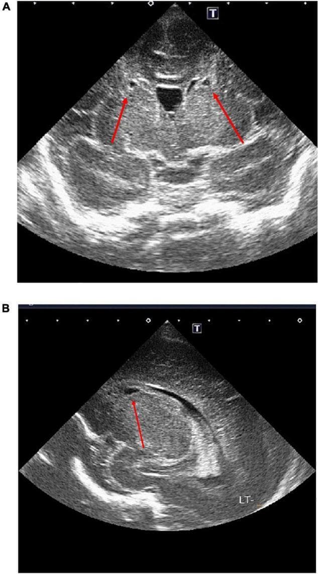 This diagnostic image displays two panels (A and B) of a neonatal head ultrasound (cranial ultrasound) illustrating cystic changes in the periventricular white matter. Panel A shows a coronal view where red arrows indicate bilateral, small, anechoic (fluid-filled) cystic lesions positioned symmetrically adjacent to the anterior horns of the lateral ventricles. Panel B provides a sagittal or parasagittal view (marked 'LT-' for left side) showing a similar discrete cystic abnormality within the periventricular region near the anterior horn. These findings are characteristic of periventricular leukomalacia (PVL), likely Grade 2 based on the localized punctate cystic morphology. The ultrasound serves as a critical bedside diagnostic tool for assessing white matter injury in preterm or high-risk neonates, providing evidence of potential hypoxic-ischemic damage or inflammatory response in the brain's germinal matrix and white matter zones.