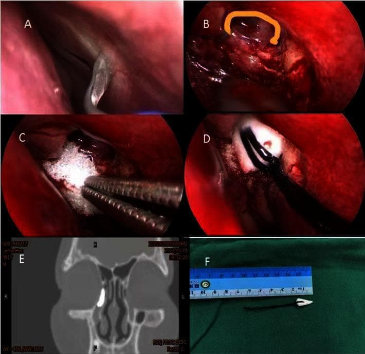 This composite figure illustrates the surgical steps and outcomes of a modified endoscopic dacryocystorhinostomy (DCR) for treating nasolacrimal duct obstruction. Panel A shows the initial surgical field within the nasal cavity after application of vasoconstrictors. Panel B displays the creation of a 'C'-shaped mucosal and lacrimal sac incision near the lateral bone window, highlighted with an orange curve. Panel C depicts the intraoperative application of a white, porous gelatin sponge at the anastomosis site of the lacrimal sac and nasal mucosa, used as an alternative to suturing. Panel D shows the placement of a conical expansion sponge into the newly created ostium using surgical forceps. Panel E is a coronal dacryocystorhinography (DCRG) image showing a contrast-filled right lacrimal system, confirming patency and appropriate drainage into the nasal cavity. Panel F provides an ex vivo view of the conical expansion sponge next to a surgical ruler for scale, illustrating its tapered shape and attached retrieval string. This educational material is designed for ophthalmology and otolaryngology training, focusing on minimally invasive techniques for lacrimal bypass surgery.