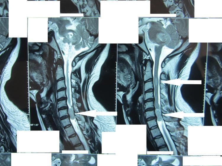 This diagnostic image consists of T2-weighted sagittal MRI views of the cervical spine, demonstrating multiple space-occupying lesions. The most prominent finding is a well-circumscribed, hyperintense extramedullary mass located at the C6-C7 level (indicated by white arrows). This lesion causes significant posterior-to-anterior displacement and compression of the spinal cord, nearly obliterating the subarachnoid space at this segment. A second, more subtle area of hyperintensity is visible within the cervical cord at a higher level, suggesting an intramedullary component or additional lesion. The vertebral bodies and disc spaces appear relatively preserved, focusing the pathology on the spinal canal. These findings are clinically significant for evaluating neurofibromatosis or multiple schwannomas, as they illustrate the relationship between extramedullary tumors and spinal cord compression (myelopathy). The images are optimized for neurosurgical planning and neuroradiology education.