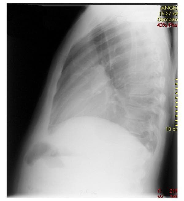 A lateral chest X-ray illustrating a massive re-accumulated pleural effusion in the left hemithorax. The image shows a large, dense area of radiopacity in the lower and middle portions of the chest, which characteristic of a significant fluid collection. This density obscures the left hemidiaphragm, the left costophrenic angle, and the posterior cardiac border. The extensive effusion results in a marked loss of lung volume on the affected side, with visible compression of the lung parenchyma. The right hemidiaphragm and right lung field appear relatively clear by comparison, though the cardiac silhouette is partially silhouette-masked by the adjacent fluid. This diagnostic image demonstrates the hallmark radiological features of massive pleural fluid accumulation, including loss of typical anatomical interfaces and increased thoracic density, serving as a primary example for pulmonary and critical care medicine education regarding pleural space pathology.