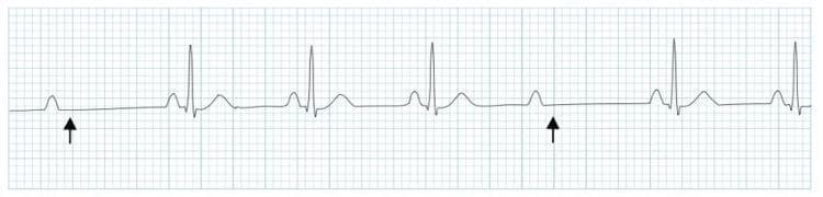 This diagnostic image is an electrocardiogram (ECG) rhythm strip illustrating Mobitz Type II second-degree atrioventricular (AV) block. The strip shows a series of P waves with a constant PR interval for conducted beats. Black arrows highlight specific P waves that are not followed by a QRS complex, indicating an intermittent failure of conduction through the AV node or His-Purkinje system. Unlike Mobitz Type I, there is no progressive lengthening of the PR interval before the dropped beat. The QRS complexes that are conducted appear narrow and maintain a consistent morphology. This rhythm strip is a classic clinical example used to teach cardiac conduction abnormalities, specifically distinguishing high-grade AV blocks that often require permanent pacemaker intervention due to the risk of progression to complete heart block.