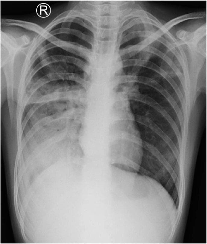 This diagnostic image is a posteroanterior (PA) chest X-ray of a 14-year-old pediatric patient showing radiographic signs of active pulmonary tuberculosis. Key visual findings include a hazy, ill-defined opacity in the right hilar region suggestive of consolidation or localized fluid accumulation. In the left pulmonary apex, there is a distinct lobulated infiltrate characterized by hazy densities with irregular margins. Additionally, the image reveals nodular densities in the left hilar region and bilateral perihilar lymphadenopathy, indicated by the widening and increased density of the hilar structures. These features collectively demonstrate a complex presentation of extensively drug-resistant tuberculosis (pre-XDR TB) involving parenchymal infiltration and significant mediastinal/hilar lymph node involvement. The image serves as a clinical example of secondary tuberculosis patterns in an adolescent, illustrating the coexistence of apical infiltrates and hilar lymphadenopathy.