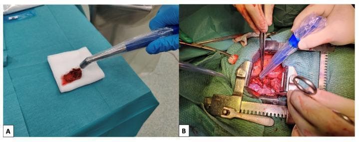 Clinical photographs demonstrating sentinel lymph node (SLN) detection techniques using a handheld gamma probe. Panel A shows an ex vivo examination of an excised lymph node specimen, which appears as a dark red, fleshy tissue on a sterile white gauze pad over a surgical drape. A gamma probe with a blue handle, encased in a sterile transparent sheath, is pointed at the specimen to measure radioactive uptake. Panel B displays the in vivo intraoperative application of the same technique. An open surgical field is maintained by a metallic self-retaining retractor, revealing deep reddish tissues and anatomical structures. The surgeon is utilizing the sterile gamma probe to scan the wound bed for any remaining radioactive 'hot spots' to identify additional sentinel lymph nodes. The image illustrates the workflow of radioguided surgery for oncological staging, focusing on the identification and removal of SLNs following the injection of a radioactive tracer.