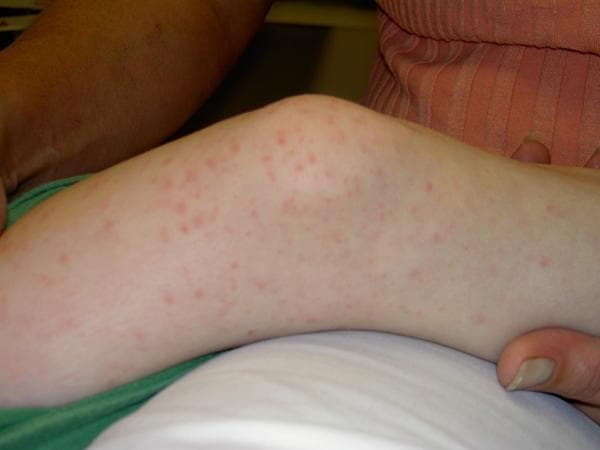 This clinical photograph displays the lower extremity of a pediatric patient, specifically focusing on the knee and proximal lower leg. The skin exhibits a generalized, non-confluent exanthem. The rash is composed of multiple small, discrete, erythematous pinkish-red macules and occasional fine papules. The distribution is widespread and random across the visible cutaneous surface, with no distinct linear or dermatomal clustering. The individual lesions are small, round, and flat, consistent with a macular morphology. The surrounding skin appears pale and non-icteric. This visual finding is characteristic of various systemic infectious or inflammatory conditions, such as viral exanthems, early Kawasaki disease, or rickettsial infections like Rocky Mountain Spotted Fever, where blanching macular and petechial rashes often involve the extremities.