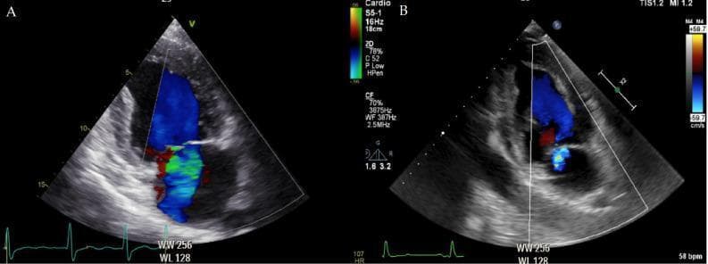 This diagnostic image consists of two side-by-side transthoracic echocardiograms (apical four-chamber views) using color Doppler imaging to evaluate mitral regurgitation (MR). Image A depicts a patient with severe aortic stenosis (AS) and concomitant moderate mitral regurgitation. A large, prominent color jet is visible, characterized by a blue mosaic pattern indicating flow away from the transducer into the left atrium, with significant turbulent flow (aliasing) represented by green and red speckling. This reflects high-velocity regurgitant flow due to left ventricular pressure overload. Image B shows the same patient 24 hours after transcatheter aortic valve replacement (TAVR). The color Doppler signal is markedly reduced to a trace regurgitant jet, demonstrating a significant decrease in the spatial extent and intensity of the flow. This comparative visual illustrates the hemodynamic interdependence of valvular lesions, where the correction of aortic stenosis and subsequent normalization of left ventricular systolic pressure lead to an immediate functional improvement in mitral valve competence.