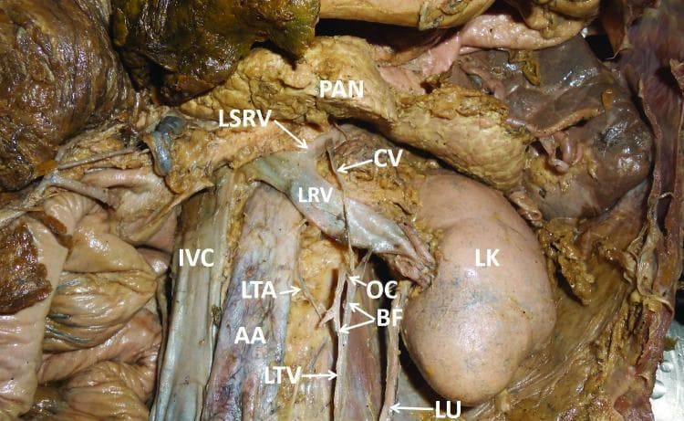 This clinical photograph displays a gross anatomical dissection of the posterior abdominal wall in a human cadaver, highlighting a rare anatomical variant of the left testicular vein (LTV). The LTV is seen ascending retroperitoneally toward the left renal vein (LRV). Unusually, it bifurcates (BF) into two distinct branches before terminating into the LRV. An oblique communication (OC) is visible between these two branches. Additionally, a slender communicating vein (CV) is observed passing anterior to the LRV to drain directly into the left suprarenal vein (LSRV). Key landmarks shown include the abdominal aorta (AA), inferior vena cava (IVC), left kidney (LK), and pancreas (PAN). The left testicular artery (LTA) and left ureter (LU) are also identified in their typical relative spatial positions. This specimen illustrates complex venous variations that are clinically significant for vascular, urological, and retroperitoneal surgical procedures, particularly regarding the drainage pathways of the pampiniform plexus and suprarenal systems.