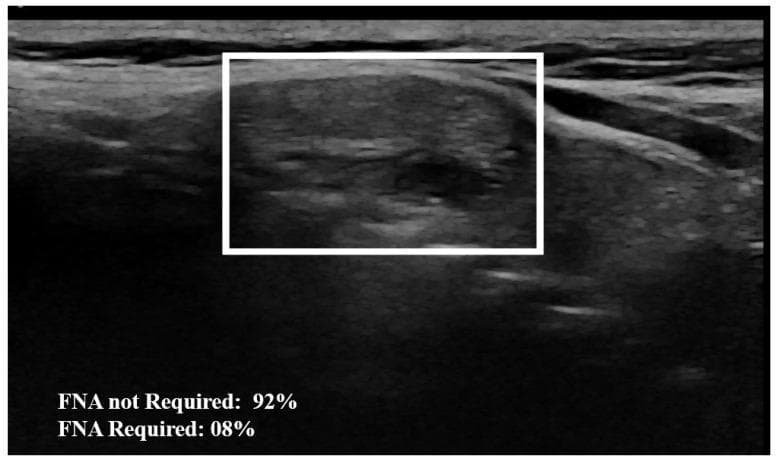 This diagnostic image is a B-mode grayscale ultrasound of the neck, specifically targeting a thyroid nodule. The central visual element is a solitary thyroid nodule highlighted within a white bounding box. The nodule exhibits a heterogeneous echo texture and mixed echogenicity, characterized by irregular internal grayscale variations. Several small hypoechoic (dark) focal areas are visible within the nodule, suggesting cystic components or internal tissue complexity. The surrounding thyroid parenchyma and adjacent anatomical structures, likely including strap muscles and connective tissue planes, appear more homogeneous and demonstrate a smoother texture compared to the coarse interior of the nodule. The image includes an overlaid AI-based classification score at the bottom, indicating a 92% probability that the nodule does not require fine-needle aspiration (FNA). This visual is intended for medical education on thyroid sonography, nodule characterization, and the integration of artificial intelligence in radiological risk assessment.
