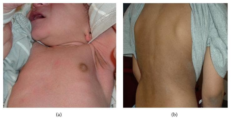 Two-panel clinical photograph demonstrating cutaneous hyperpigmentation associated with pediatric adrenal insufficiency. Panel (a) shows the anterior chest and axilla of a 10-day-old male infant. Notable findings include marked hyperpigmentation of the nipple and areola, as well as the axillary vault, contrasting with the lighter surrounding skin. This presentation is characteristic of salt-wasting congenital adrenal hyperplasia (CAH) due to 21-hydroxylase deficiency. Panel (b) displays the posterior torso of a 9-year-old male with Addison's disease, showing diffuse, generalized bronzing of the skin with subtle mottling. Pathophysiologically, these skin changes result from elevated levels of adrenocorticotropic hormone (ACTH) and melanocyte-stimulating hormone (MSH) due to lack of cortisol negative feedback. The images highlight key diagnostic dermatologic signs of primary adrenal insufficiency in different pediatric age groups, emphasizing the importance of examining skin creases and pigmented areas for early clinical recognition of endocrinological disorders.