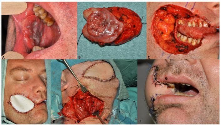 This composite clinical and intraoperative photograph series documents a two-staged, delayed reconstruction for oral cavity cancer (pT2N2bM0) in a 44-year-old male. Panel A shows the preoperative clinical photograph of a large, ulcerated, and heterogeneous malignant mass involving the buccal mucosa. Panel B displays the resected specimen, illustrating the tumor's margins and deep tissue involvement. Panel C captures the significant full-thickness surgical defect immediately after resection, exposing the tongue and dentition. Panel D illustrates temporary wound management using a double-layered artificial skin substitute (EpiGARD®) as a temporary lining to protect the oral mucosa and external facial defect. Panel E depicts the second-stage definitive reconstruction involving the harvest and microsurgical placement of a radial forearm free flap to provide vascularized soft tissue coverage. Panel F shows the patient two weeks post-operatively, demonstrating initial healing with visible sutures and the successful restoration of facial contour. The series serves as an educational resource for surgical oncology, plastic surgery, and maxillofacial reconstruction, highlighting strategies for managing complex head and neck defects when immediate reconstruction is deferred.