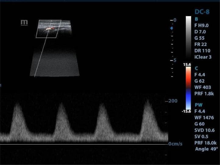 This diagnostic image is a duplex ultrasound of the left lower limb, specifically targeting the superficial femoral artery (SFA). The top portion shows a B-mode ultrasound with a color Doppler overlay, displaying a mixture of red and blue signals within the vessel lumen, suggesting turbulent or complex flow patterns. The lower portion of the image contains a pulse-wave (PW) spectral Doppler display showing a monophasic waveform pattern. This waveform is characterized by a loss of the normal triphasic arterial signal, showing instead a slow upstroke and a single, broad peak followed by a gradual decay without a diastolic reversal component. Four distinct cardiac cycles are visible. Such monophasic waveforms in the peripheral arteries are clinically significant as they often indicate significant proximal arterial stenosis or occlusion, reflecting a dampened 'tardus parvus' flow distal to a high-grade obstruction. The image includes technical parameters such as a pulse repetition frequency (PRF) of 18.0k and an insonation angle of 49 degrees.