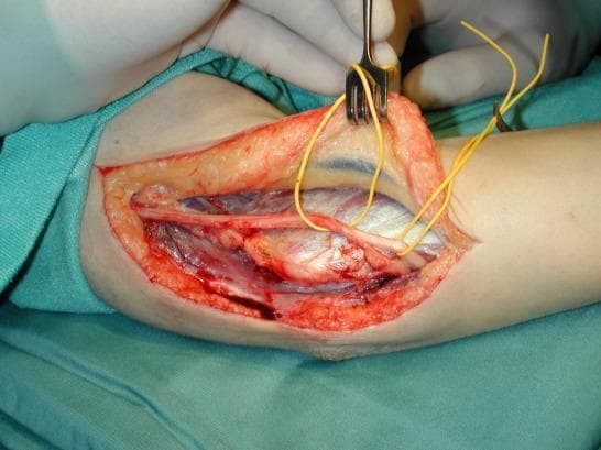 This clinical photograph displays an intraoperative view of an open surgical procedure on the medial aspect of the elbow, specifically illustrating a subcutaneous transposition of the ulnar nerve for the treatment of cubital tunnel syndrome. The incision reveals several anatomical layers, including skin, a thick layer of yellowish lobular subcutaneous fat, and underlying muscle fascia. The ulnar nerve is clearly identified as a slender, yellowish-white cord-like structure that has been mobilized from its native position in the cubital tunnel. It is being retracted and supported by yellow vessel loops and a metal rake retractor. The surgical field also shows deep venous structures and dissected muscular tissue with visible striations. The procedure demonstrates the transposition technique where the nerve is relocated anteriorly to the medial epicondyle to relieve compression and tension during elbow flexion. This image serves as a teaching tool for orthopedic and neurosurgical trainees to understand the surgical anatomy and topographical shifts involved in peripheral nerve decompression.