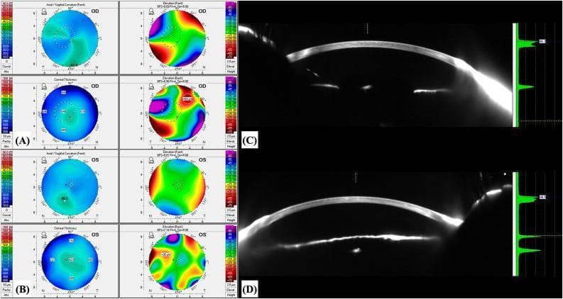 This composite diagnostic image displays corneal tomographic and densitometric analysis for both eyes (OD and OS) of a patient using the Pentacam® AXL system. Panels (A) and (B) present 4-map refractive displays for the right and left eyes, respectively, including axial/sagittal curvature, anterior and posterior elevation maps, and corneal thickness (pachymetry) maps. The curvature maps show relatively regular astigmatism, while the thickness maps illustrate the spatial distribution of the cornea, highlighting areas of thickening or thinning. Panels (C) and (D) provide Scheimpflug photographs showing cross-sectional views of the anterior segment. Adjacent to these photographs are densitometry histograms that quantify light scattering (backscatter) across the corneal layers. These scans are used to evaluate corneal pathologies such as peripheral corneal edema or Brown-McLean syndrome, as indicated by the characteristic densitometry spikes and pachymetric shifts. The images demonstrate the relationship between corneal structure, thickness variations, and optical transparency in a clinical ophthalmological assessment.