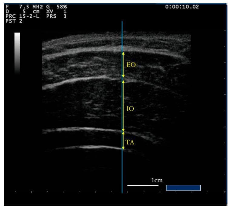 This diagnostic ultrasound image demonstrates the transverse cross-sectional anatomy of the lateral abdominal wall muscles. Three distinct layers are visible: the most superficial External Oblique (EO), the middle Internal Oblique (IO), and the deepest layer, the Transverse Abdominis (TA). The muscle bodies are characterized by relatively hypoechoic (darker) echotexture with internal speckling, separated by bright, hyperechoic fascial planes that define their boundaries. A vertical blue reference line intersects the layers to ensure consistent measurement. Yellow double-headed arrows indicate the specific thickness measurements for each of the three muscles. A 1cm scale bar is provided in the bottom right corner for quantitative assessment. This imaging modality is typically used in sports medicine and physical therapy to assess core muscle activation, hypertrophy, or atrophy through real-time visualization of muscle thickness changes during exercises like the Abdominal Drawing-In Maneuver (ADIM) or abdominal bracing.