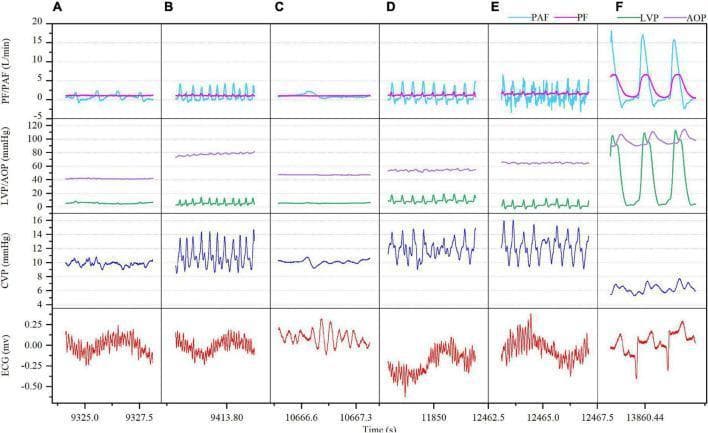 Multi-panel physiological waveform series demonstrating hemodynamic changes during ventricular fibrillation (VF) and subsequent defibrillation in the context of a continuous-flow left ventricular assist device (CF-LVAD). The image consists of a grid with six time-sequenced panels (A-F) tracking four parameters: Flow rates (PF: Pump Flow in pink, PAF: Pulmonary Artery Flow in cyan), Pressures (LVP: Left Ventricular Pressure in green, AOP: Aortic Pressure in purple), Central Venous Pressure (CVP in dark blue), and Electrocardiogram (ECG in red). Panels B-E illustrate the progression of sustained VF over 60 minutes, characterized by disorganized ECG activity and a compensatory increase in CVP amplitude and baseline (rising from ~10 to 14 mmHg). During VF, LVP and AOP remain significantly depressed with low pulsatility. Panel F displays the hemodynamic recovery post-defibrillation, showing the restoration of organized QRS complexes on ECG, a return of high-amplitude rhythmic pulsatility in LVP/AOP, and a significant reduction in CVP toward a stable baseline, signifying successful conversion to sinus rhythm and restored biventricular output.