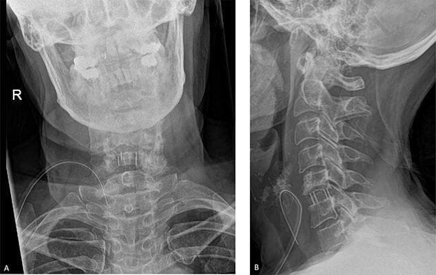 Post-operative cervical spine radiographs demonstrating an anterior cervical discectomy and fusion (ACDF) at the C5-C6 level. Panel A shows an anteroposterior (AP) view, while Panel B provides a lateral view. Visible surgical hardware includes a radiopaque interbody fusion cage positioned within the C5-C6 disc space to restore and maintain foraminal height. Small circular markers associated with the cage and longitudinal Caspar pins used for distraction are visible within the C5 and C6 vertebral bodies. The lateral view demonstrates preserved cervical lordosis and correct sagittal alignment of the C2-C7 vertebrae. Anterior soft tissue shadows are present, consistent with the surgical approach. This image is used to educate on spinal decompression techniques and the radiological appearance of cervical stabilization hardware in neurosurgery and orthopedics.