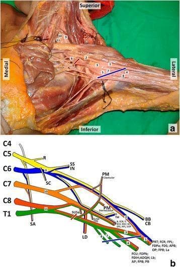 This composite educational resource details the anatomy and innervation of the brachial plexus. Panel (a) is a cadaveric dissection of the left axillary region. Key structures are labeled numerically: the median nerve (1), lateral and medial roots of the median nerve (2, 3), ulnar nerve (4), axillary artery (5), and axillary vein (6), alongside the medial cutaneous nerves of the arm (7) and forearm (8). In the supraclavicular region, the upper (9), middle (10), and lower (11) trunks are identified. Red and blue lines indicate proximal and distal bounds of a clinical lesion site. Panel (b) is a color-coded schematic diagram illustrating the brachial plexus architecture from roots (C5-T1) to terminal branches. It maps specific nerves to their target muscles, including the serratus anterior, deltoid, biceps brachii, and the intrinsic muscles of the hand. This content is designed for medical students and surgical residents to understand the relationship between neuroanatomical structures, their physiological territories, and the clinical correlation of axillary nerve injuries.