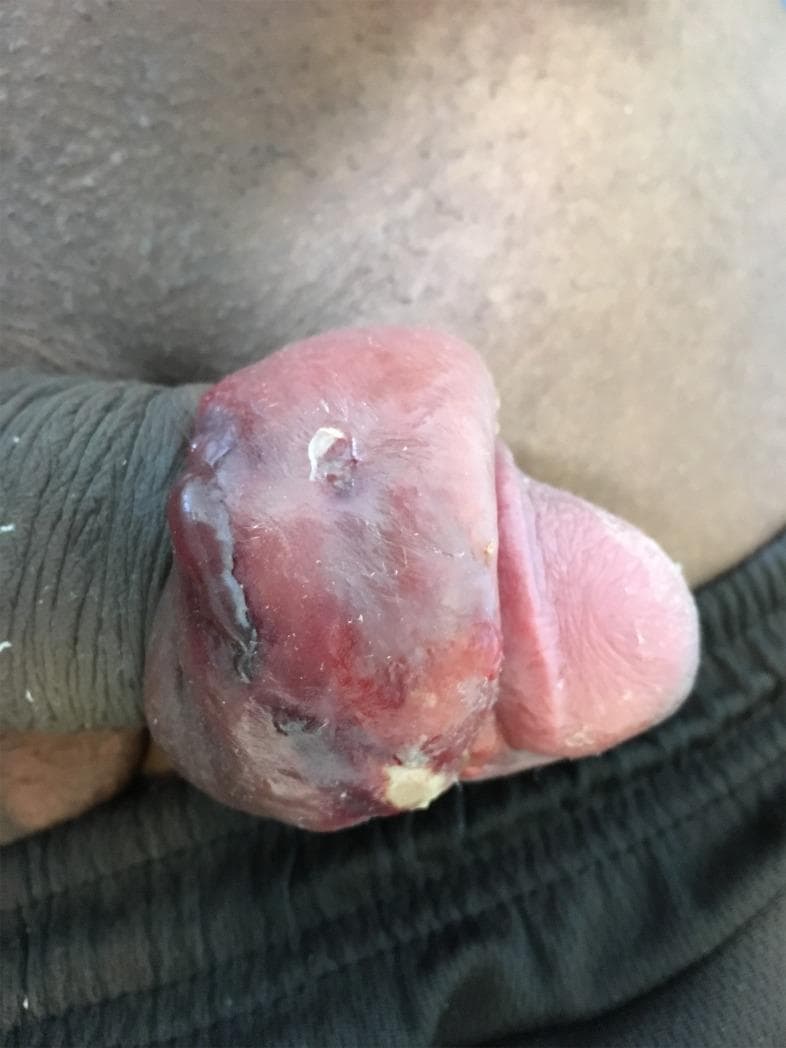 This clinical photograph illustrates a case of infectious paraphimosis, a urological emergency, following the subcutaneous insertion of a penile implant. The image shows the penis with the foreskin severely retracted and trapped behind the glans penis, forming a tight, constricting band. There is marked, circumferential edema and distortion of the prepuce and glans. The tissue exhibits a mottled appearance with varied coloration, including intense erythema and dark reddish-purple areas, suggesting severe inflammation and vascular congestion. Visible signs of infection include whitish purulent exudate on the surface of the swollen tissue and small areas of skin breakdown or ulceration. Superficial skin lacerations are present, potentially serving as the portal of entry for pathogens. This image serves as an educational example of short-term postoperative complications and infectious sequelae associated with non-medical penile modifications.