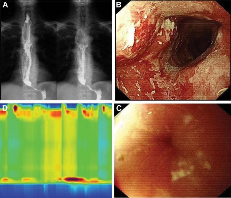 This composite diagnostic image illustrates the clinical findings of achalasia through multiple modalities. (A) Barium swallow (upper GI angiography) displays a significantly dilated esophageal lumen with a classic 'bird’s beak' sign, characterized by smooth, symmetric tapering at the gastroesophageal junction. (B, C) Endoscopic views (EGD) demonstrate stagnant food residue and extensive white mucosal plaques in the mid-esophagus, suggestive of secondary candidiasis or stasis-induced changes. View C specifically shows a tightly closed cardia that provided resistance to the endoscope. (D) A high-resolution esophageal manometry (HRM) topographic plot reveals aperistalsis in the esophageal body (low-pressure/green zones) and impaired relaxation of the lower esophageal sphincter (LES), indicated by persistent high-pressure bands at the distal end. Together, these images teach the classic triad of achalasia: esophageal dilation, failure of LES relaxation, and loss of peristalsis, useful for gastroenterology and radiology trainees.