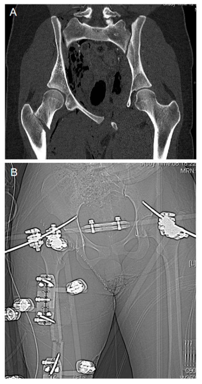 This composite figure illustrates damage control orthopedics in a severe trauma case. Figure A is a coronal CT scan image showing a displaced 'open book' pelvic ring fracture characterized by significant widening (diastasis) of the symphysis pubis and disruption of the sacroiliac joints. Additionally, a comminuted fracture of the right proximal femur with lateral displacement of the distal fragment is visible. Figure B is an anteroposterior (AP) x-ray radiograph (scout view) showing the post-operative state after emergency stabilization. An external fixation frame is in situ, utilizing percutaneous Schanz pins and connecting rods to bridge and stabilize the pelvic ring and the right femur fracture. A pelvic binder or similar radiopaque compression device is also visible across the mid-pelvis. The image demonstrates the transition from acute traumatic instability to mechanical stabilization as part of a life-saving orthopedic intervention to manage hemorrhage and prevent further soft tissue injury.