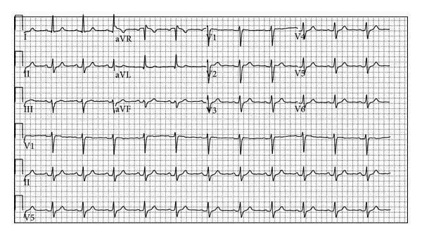 A standard 12-lead electrocardiogram (ECG) displayed on a traditional grid background. The tracing shows a normal sinus rhythm with a heart rate estimated at approximately 60–80 beats per minute. Each QRS complex is preceded by a clear, upright P wave in the inferior leads (II, III, and aVF). The PR interval and QRS duration appear to be within normal limits. The QRS complexes demonstrate normal axis and progression across the precordial leads (V1-V6). The ST segments are predominantly isoelectric, and T waves are upright in most leads, including leads I, II, aVF, and V3-V6. No overt signs of acute ischemia, such as significant ST-segment elevation or depression, are readily identifiable in this initial recording. The image serves as a baseline clinical diagnostic tool for evaluating cardiac electrical activity in a patient presenting with syncope, illustrating the transition from a seemingly unremarkable initial ECG to subsequent diagnostic findings associated with Brugada syndrome.