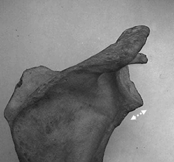 This clinical photograph displays a dry bone cadaveric specimen of a human scapula, viewed from a posterior perspective to highlight the morphology of the glenoid neck. Key anatomical landmarks include the glenoid fossa positioned laterally, the coracoid process extending superiorly and anteriorly, and the acromion process. The focal point is the 'long-neck' variation of the glenoid, where the distance between the glenoid articular surface and the medial scapular body is elongated. A white, double-headed dashed arrow is placed at the inferior aspect of the glenoid neck to visually emphasize this longitudinal dimension. The image serves as an educational reference for orthopedic anatomy and morphometric studies, demonstrating variations in scapular architecture that influence biomechanics and the placement of glenoid components in total shoulder arthroplasty.