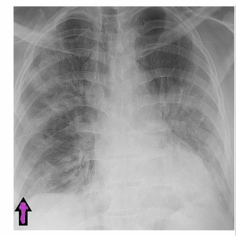 A posterior-anterior (PA) view chest X-ray illustrating characteristic findings in a patient with viral pneumonia, such as COVID-19. The image demonstrates bilateral hazy lung opacities and infiltrates, primarily distributed across both the middle and lower lung zones. These findings represent increased density compared to healthy lung parenchyma, indicative of inflammatory processes. A purple arrow at the right base highlights a clear costophrenic angle, confirming the absence of pleural effusion or pneumothorax at the time of admission. The cardiac silhouette and mediastinal contours appear within normal limits. The clavicles, ribs, and vertebrae are visible and intact. This diagnostic image is used to teach students how to identify multifocal ground-glass opacities and infiltrates on plain radiography, as well as how to differentiate them from secondary complications like pneumomediastinum or fluid accumulation in the costophrenic recesses.