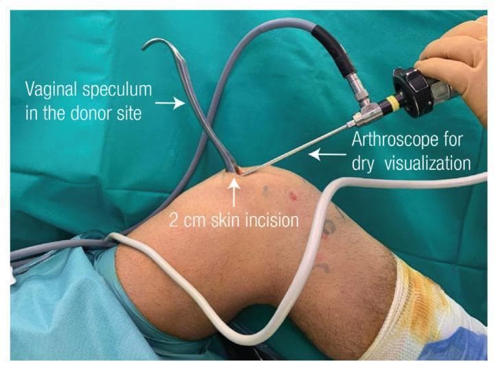 This clinical photograph captures a surgical procedure on a human right knee, specifically the donor site for a quadriceps tendon (QT) graft. The image illustrates an innovative surgical technique where a simple vaginal speculum is repurposed as a retractor. The speculum's metal blades are inserted into a 2-cm longitudinal skin incision located approximately 1 cm proximal to the superior pole of the patella. By expanding the subcutaneous space, the speculum acts as a 'tent' to facilitate 'dry arthroscopy,' which is being performed with a hand-held arthroscope inserted through the same incision. The arthroscope is connected to a thick gray image transmission cable and a white light source cable. This setup allows for clear visualization of the quadriceps tendon borders and the myotendinous junction without fluid distension, supporting precise graft harvesting and side-to-side defect closure. The procedure is shown in an intraoperative setting with green sterile draping and the patient's knee in a flexed position, highlighting technical adaptations in orthopedic surgery.
