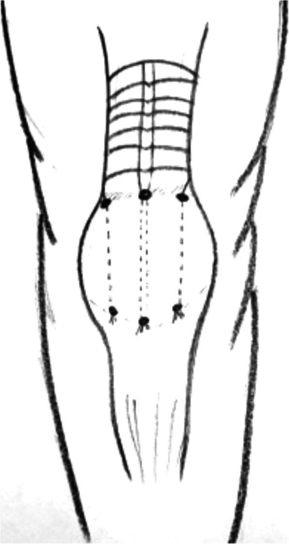 Anatomical Diagram of the Knee Extensor Mechanism. This schematic illustration depicts a surgical approach for repairing the patellar tendon or quadriceps tendon, particularly in the context of chronic ruptures. The diagram features a central circular patella situated between the proximal quadriceps muscle and the distal tibia/fibula. Surgical markings are indicated by six black dots: three positioned at the superior pole of the patella and three at the inferior pole. These dots are connected by three longitudinal dashed lines—one central and two paracentral—representing transosseous tunnels or suture pathways designed to secure the tendon to the bone. Proximal to the patella, a series of horizontal lines represents the quadriceps muscle, potentially indicating a V-Y advancement or lengthening procedure (Codivilla technique). The illustration serves as an educational guide for orthopedic surgical planning in patients with complex extensor mechanism injuries, such as those associated with systemic comorbidities like tertiary hyperparathyroidism.