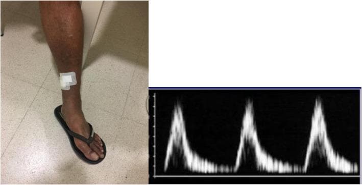 This composite educational image illustrates Peripheral Artery Disease (PAD) through clinical and diagnostic correlations. The left panel is a clinical photograph of a patient's lower limb, showing a medium-toned leg with a white adhesive medical dressing applied near the medial aspect of the distal third of the leg/ankle area, typically used to cover and protect skin ulcers. The right panel displays a Doppler ultrasound spectral waveform of the lower limb arteries. The waveform exhibits signs of suprapopliteal arterial stenosis, characterized by an increased systolic rise time (delayed acceleration) and a loss of normal triphasic pulsatility, resulting in a more monophasic appearance. This combination of visual evidence demonstrates the physical manifestation of arterial insufficiency (ulceration requiring dressing) and the underlying hemodynamic abnormality (impaired arterial flow) essential for diagnosing vascular disease. The image is intended for medical students and clinicians to recognize the relationship between clinical findings of ischemic ulcers and diagnostic vascular echography in PAD cases.