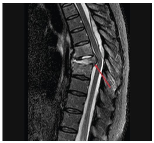 This diagnostic image is a sagittal T2 Short Tau Inversion Recovery (STIR) MRI of the thoracic spine. It demonstrates signs of spondylodiscitis at the T6-T7 level. Key visual features include hyperintensity within the T6-T7 intervertebral disc and the absence of the normal low-signal internuclear cleft, suggesting disc inflammation or edema. The adjacent T6 and T7 vertebral bodies also exhibit significant hyperintensity, indicating bone marrow edema. There is a visible vertebral collapse and a posterior inflammatory/infectious lesion, indicated by a red arrow, that is causing posterior displacement and compression of the dural sac and the spinal cord. This imaging finding is characteristic of infectious discitis-osteomyelitis with secondary neurological compromise, frequently seen in fungal infections like paracoccidioidomycosis or tuberculosis (Pott's disease) in immunosuppressed patients.