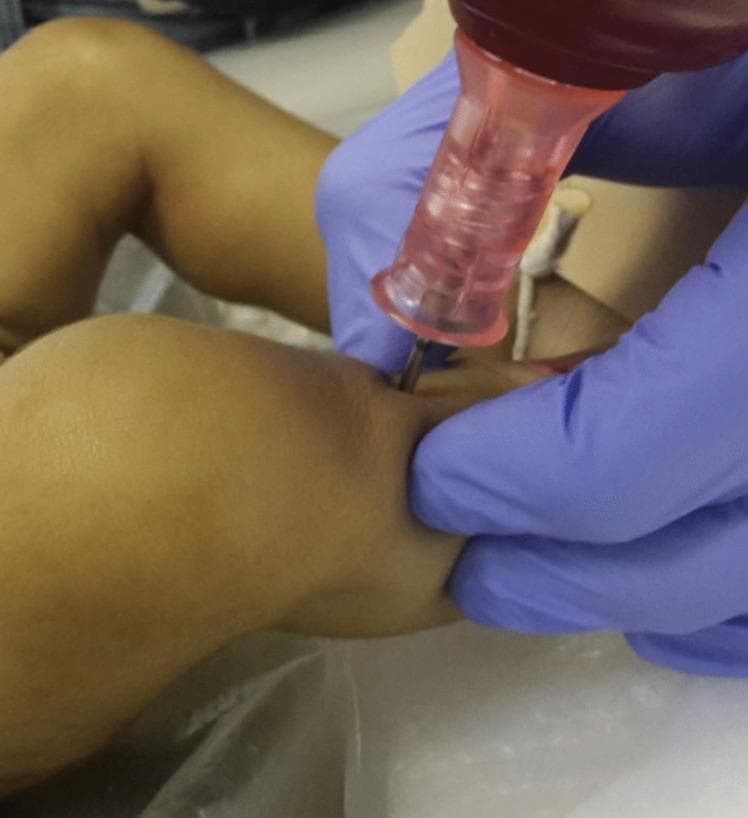 This procedural photograph demonstrates the establishment of intraosseous (IO) access in the proximal tibia of a pediatric patient, likely in a postmortem or emergency clinical setting. The image shows a close-up view of a lower extremity with gloved hands performing the procedure. One hand, in a blue medical glove, stabilizes the calf to provide counter-pressure, while the other hand operates a mechanical bone drill (specifically an EZ-IO® system). The device features a dark red power driver attached to a pink translucent needle set. The needle is seen penetrating the skin at the anterior-medial aspect of the proximal tibia, just distal to the tibial tuberosity, which is the standard landmark for IO insertion to reach the marrow cavity. This visual serves to illustrate the correct anatomical positioning, perpendicular angle of insertion, and stabilization technique required for rapid vascular access when intravenous routes are unavailable. The context relates to postmortem computed tomography angiography (PMCTA) preparation.