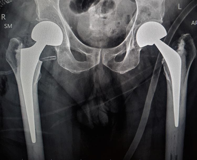 This anterior-posterior (AP) pelvic radiograph demonstrates bilateral hip hemiarthroplasty with bipolar prostheses in situ. Each prosthesis consists of a high-density, radiopaque femoral stem inserted into the medullary canal, a femoral neck, and a dual-bearing spherical head component articulating with the native acetabulum. The right hip features a recently implanted modular bipolar hemiarthroplasty, appearing well-aligned without signs of loosening. The left hip shows a long-standing cemented bipolar prosthesis, with visible cement mantle density around the femoral stem. The pelvic bony architecture, including the iliac wings, sacrum, and pubic symphysis, appears intact with age-related coarsening of the trabecular pattern. There is no evidence of periprosthetic fracture, osteolysis, or component migration. Soft tissue shadows show medical tubes and monitors consistent with an immediate postoperative setting. This image serves as a clinical example of surgical management for femoral neck fractures or advanced hip pathology using bilateral arthroplasty techniques.