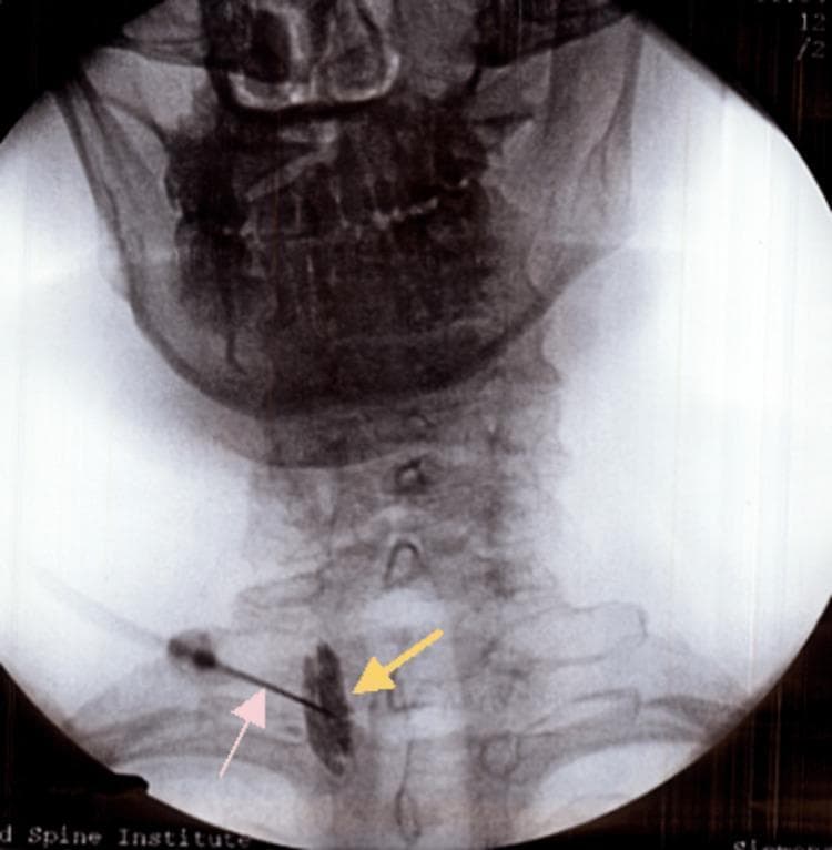This diagnostic fluoroscopic image in an anteroposterior (AP) view captures a right-sided stellate ganglion block procedure in the lower cervical spine region. The bony anatomy visible includes the base of the skull, the mandible, and the cervical vertebrae from C1 down to the cervicothoracic junction. A radiopaque linear needle or catheter (indicated by a pink arrow) is seen approaching from a lateral-to-medial direction, with its tip positioned at the level of the C6-C7 vertebral interface. Adjacent to the tip of the needle, a localized collection of radiopaque contrast medium (indicated by a yellow arrow) is visible, appearing as an irregular, elongated vertical density lateral to the vertebral bodies. This contrast pattern confirms the appropriate needle tip placement within the prevertebral fascia for the sympathetic block. The image serves as an educational example of interventional pain management techniques, specifically demonstrating fluoroscopic guidance and contrast confirmation during a cervical sympathetic nerve block for conditions such as complex regional pain syndrome (CRPS).