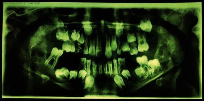 This diagnostic image is a panoramic radiograph (orthopantomogram) of a pediatric patient, demonstrating significant bilateral pathology within the mandible. The radiograph reveals extensive, well-defined, multilocular radiolucent lesions situated bilaterally. These ‘soap-bubble’ or ‘honeycomb’ appearing lesions originate in the primary molar regions and extend posteriorly to involve the entirety of the ascending rami. Notable structural changes include the marked expansion of the mandibular cortex, specifically along the inferior border and the alveolar crest. The lesions appear to displace several developing permanent tooth germs, which is characteristic of expansile jaw lesions in children, such as cherubism or giant cell granulomas. The maxillary structures and dentition are also visible, though the primary pathology is localized to the lower jaw. This visual is highly educational for dental and maxillofacial pathology, illustrating classic radiographic signs of expansile multilocular mandibular lesions and their impact on surrounding anatomical structures and dental development.