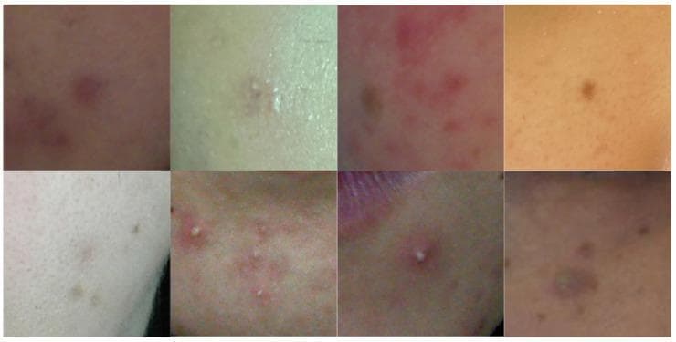 This composite clinical photograph displays multiple cropped views of facial skin demonstrating the morphological diversity of acne vulgaris. The images showcase a range of lesions across different skin phototypes, from fair to dark tones. Visible pathology includes erythematous papules (inflamed red bumps), pustules characterized by central white purulent material (whiteheads), and closed comedones. Some regions exhibit post-inflammatory hyperpigmentation, appearing as brownish or purplish macules following lesion resolution. The distribution varies from discrete, isolated lesions to clusters of inflamed, irregularly shaped papules. Textural irregularities are evident, ranging from smooth elevations to rough, crusting surfaces and prominent follicular openings. This collection serves as a dermatological reference for identifying acne manifestations, highlighting variations in lesion color (red, pink, white, brown) and morphology (papular, pustular, comedonal) essential for diagnostic training and the development of automated medical imaging segmentation algorithms.